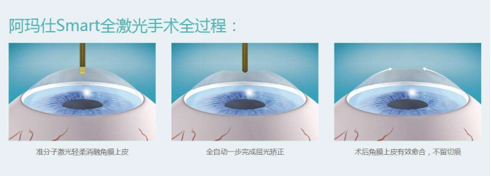 最新近视眼手术，光明之路，重塑视界未来